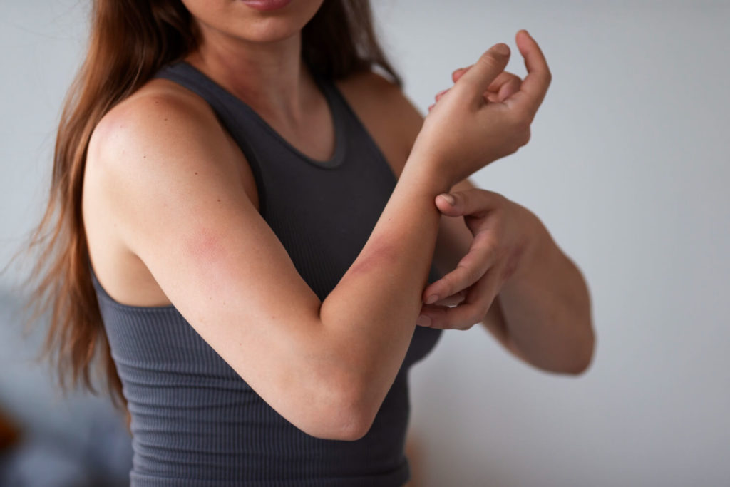woman-suffering-from-rash